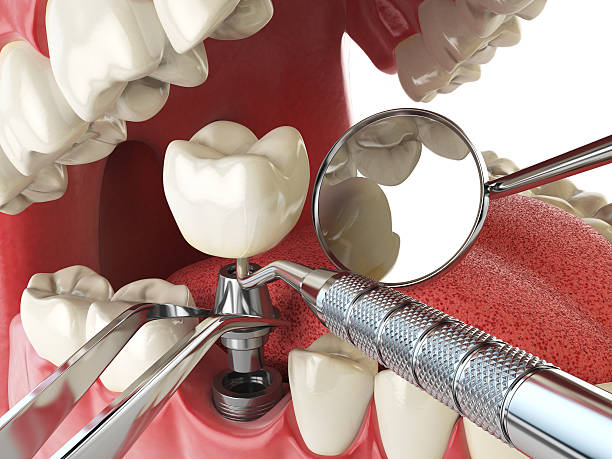 Best Urgent Tooth Repair  in Kent, WA